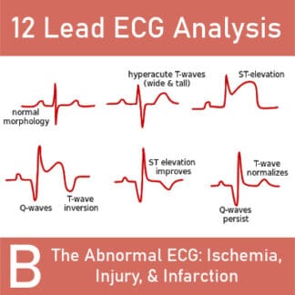 12 Lead ECG Analysis B: The Abnormal ECG: Ischemia, Injury, & Infarction