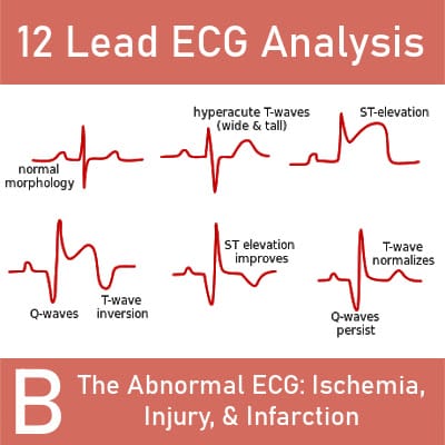 12 Lead ECG Analysis B: The Abnormal ECG: Ischemia, Injury, & Infarction